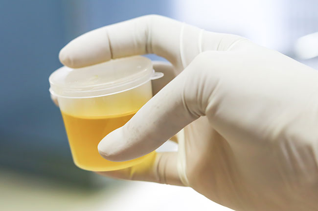Sterk ruikende urine overgang
