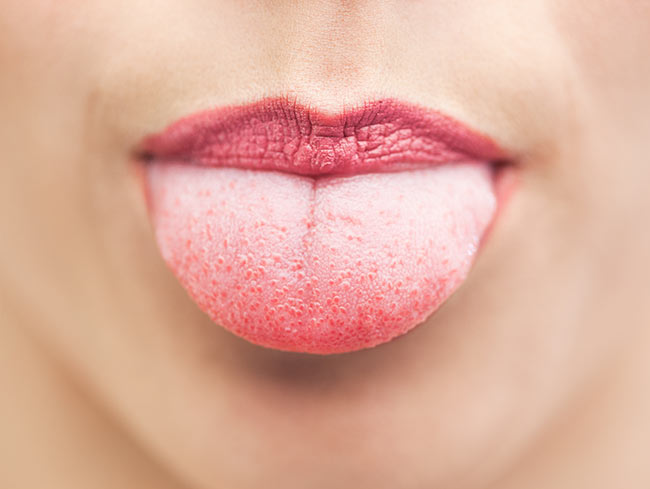 Tong gezondheid-witte tong